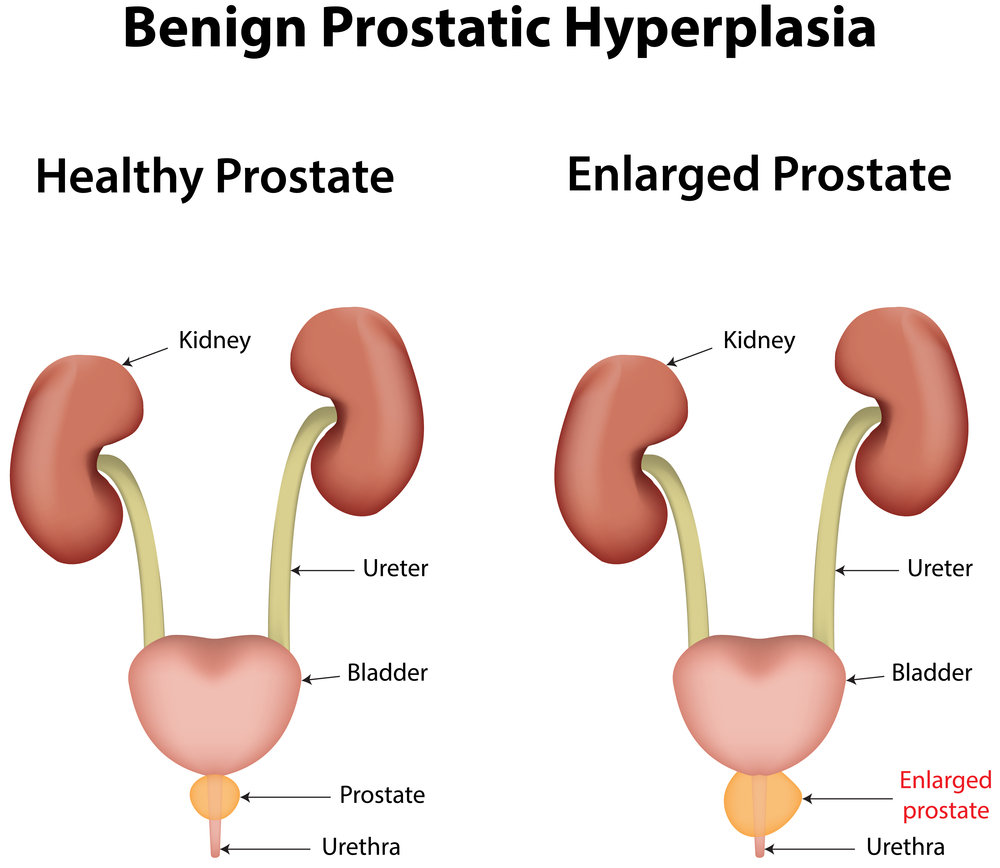 proscar and flomax after turp